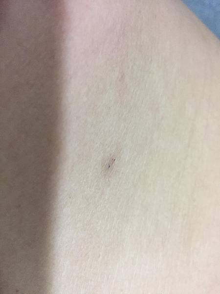 狐臭怎麼改善,狐臭手術,超音波狐臭震盪法,狐臭,李岳樺醫師,博恩妍